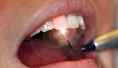 Zahnarzt Bochum Laserbehandlung