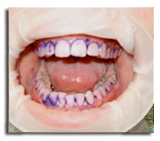Zahnarzt Bochum Parodontosebehandlung