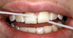 Zahnzwischenraum, Reinigung, Zahnarztpraxis Bochum