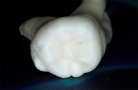 Zahnarzt Bochum: Fissurenversiegelung, der zu versiegelnde Zahn