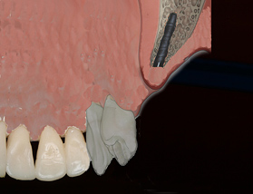 Implantat im aufgedehnten Knochen - Zahnarzt Herne